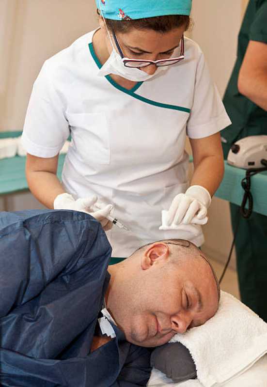 Cirurgia Capilar para Calvície Caierias - Cirurgia de Implante Capilar na Testa
