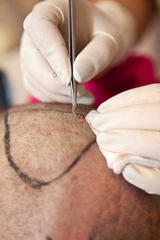 Cirurgia de Calvície Guaraí - Cirurgia de Implante Capilar para Redução de Testa
