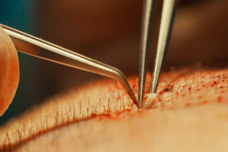 Cirurgia de Transplante de Cabelo Cacheado Valores Niquelandia - Cirurgia de Transplante de Cabelo Liso