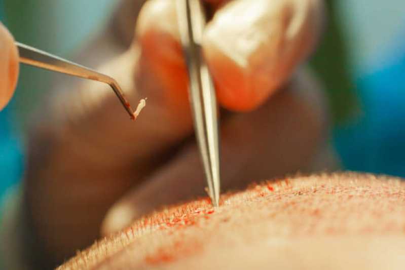 Cirurgia de Transplante de Cabelo Cacheado Cajamar - Cirurgia de Transplante de Cabelo para Homens