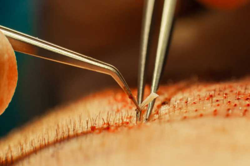 Cirurgia de Transplante de Cabelo Masculino Valores Formosa - Cirurgia de Transplante de Cabelo Masculino