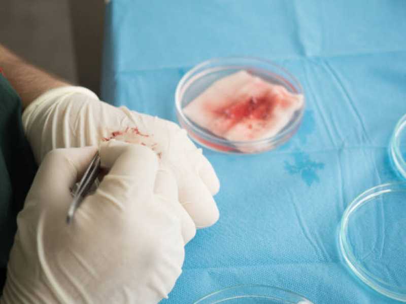 Cirurgia de Transplante de Cabelo para Mulheres Planaltina - Cirurgia de Transplante Cabelo Masculino