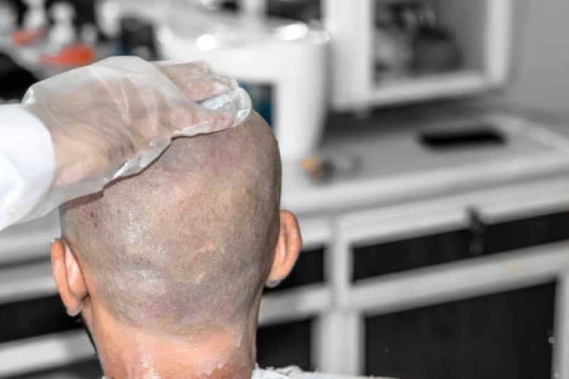 Cirurgia Transplante Capilar Preços Salesópolis - Cirurgia de Transplante de Cabelo para Homens