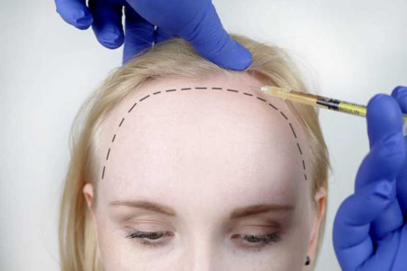Cirurgia Transplante Capilar Parauapebas - Cirurgia de Transplante de Cabelo para Mulheres