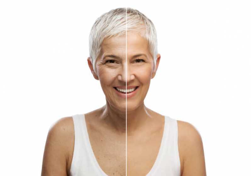 Clínica de Estética Facial Preenchimento Vargem Grande Paulista - Clínica de Estética Facial com Peeling
