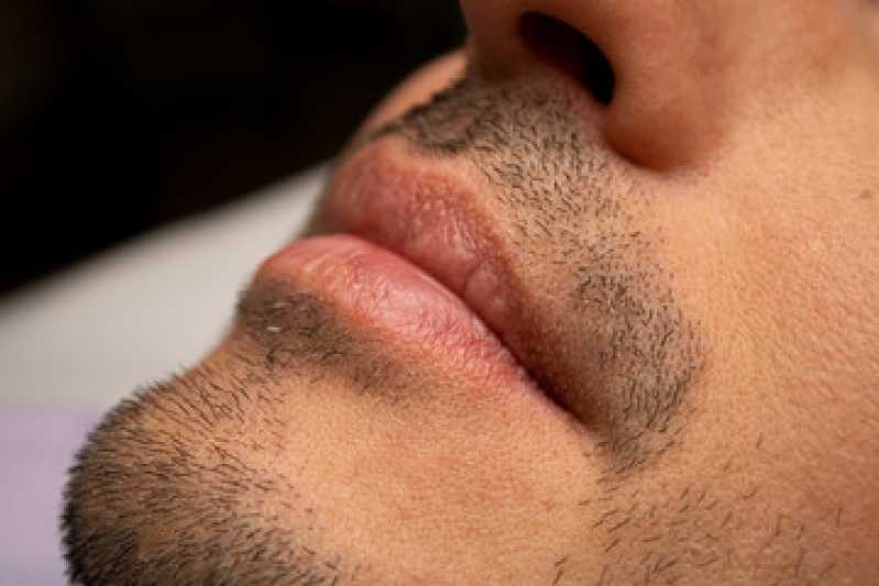 Clínica de Implante Bigode Aruanã - Clínica de Implante para Barba Rala