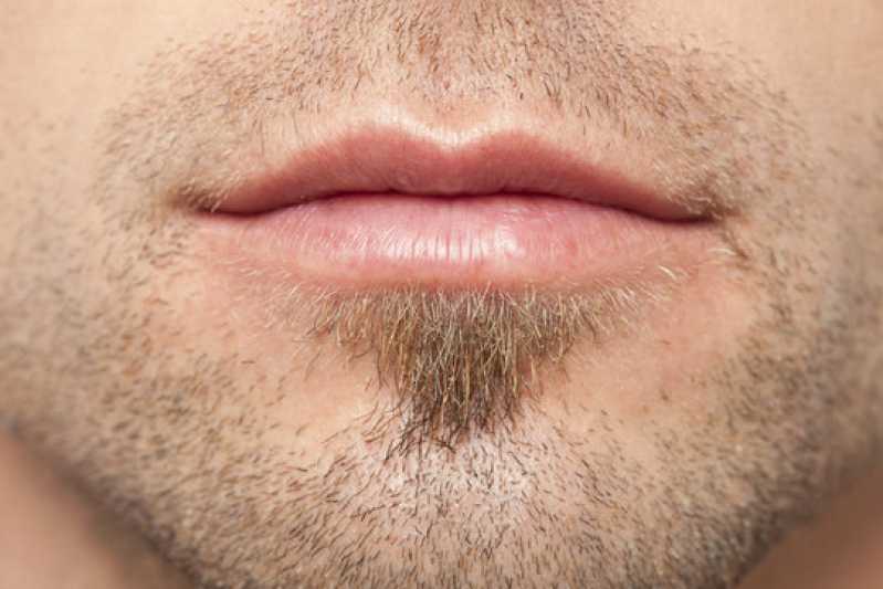 Clínica de Implante Capilar Barba Telefone Barra do Garças - Clínica de Implante na Barba