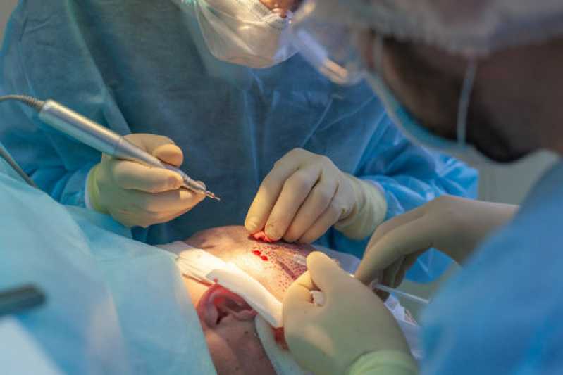 Clínica de Implante Capilar Feminino Contato Caieiras - Clínica de Implante Capilar Fut