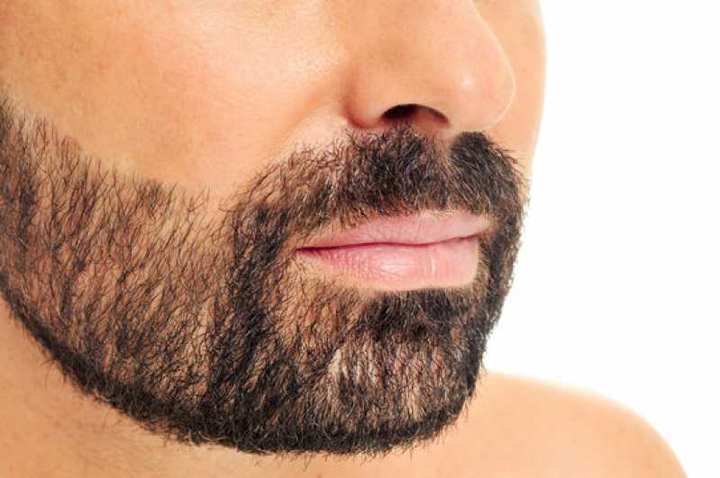 Clínica de Implante Capilar para Barba Telefone Barra do Garças - Clínica de Implante Capilar na Barba