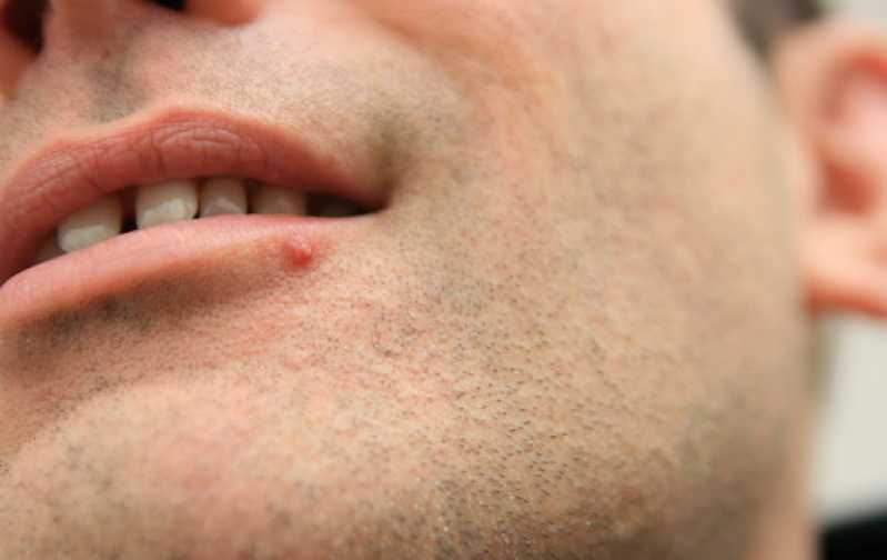 Clínica de Implante Capilar para Barba Caldas Novas - Clínica de Implante Capilar para Barba Rala