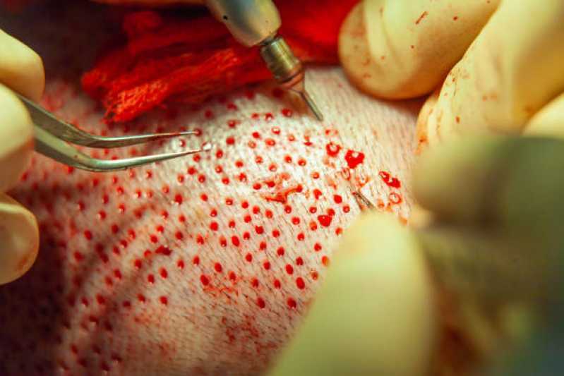 Clínica de Implante de Cabelo Telefone Rio Quente - Clínica Transplante Capilar