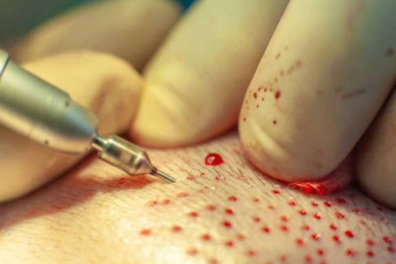 Clínica de Implante de Cabelo Carapicuíba - Clínica para Tratamento de Cabelo