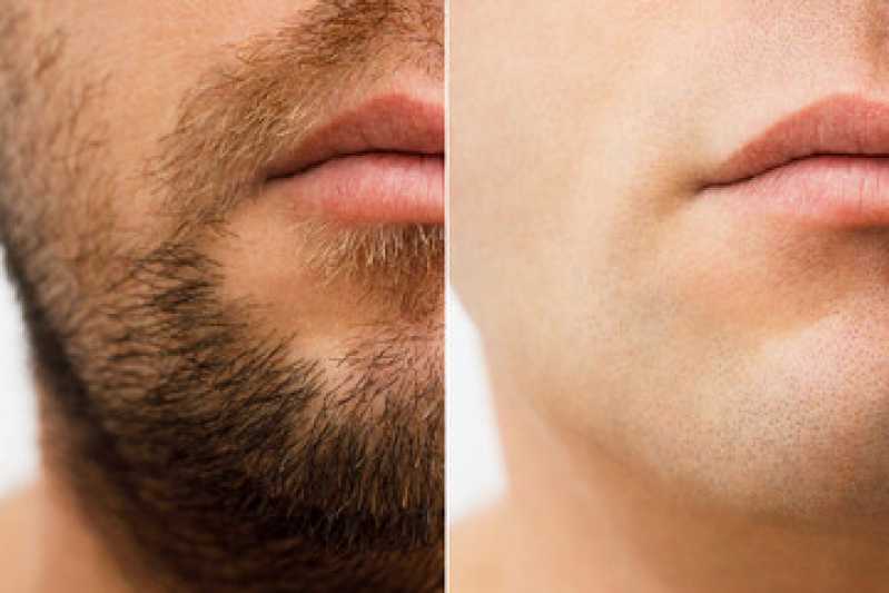Clínica de Implante para Barba Rala Telefone Caierias - Clínica de Implante Capilar Barba