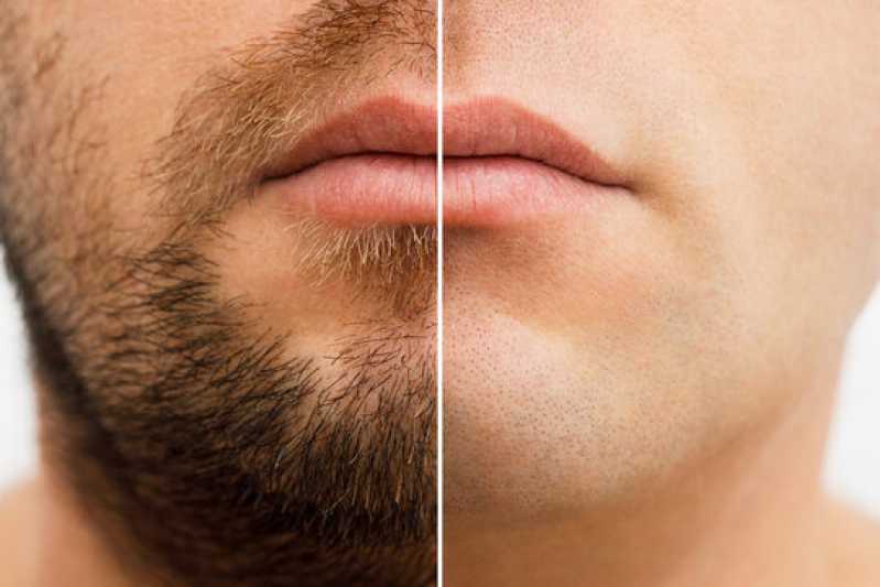 Clínica de Implante para Barba Rala Jardim Elias - Clínica de Implante Capilar para Barba