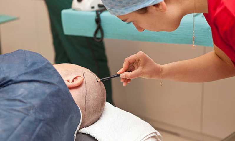 Clínica Especializada em Cirurgia Capilar Fue Parauapebas - Cirurgia de Implante de Cabelo