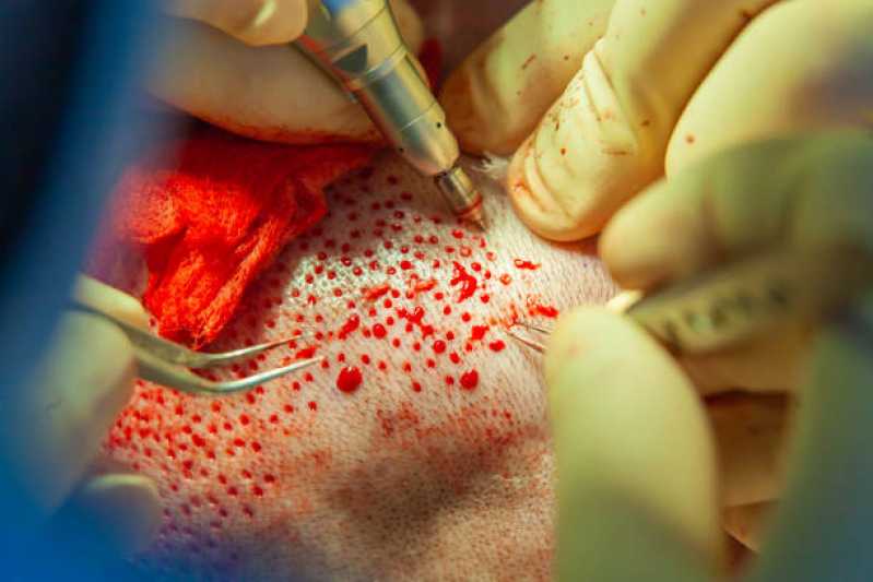Clínica Especializada em Cirurgia de Transplante Cabelo Feminino Lençóis Paulista - Cirurgia de Transplante de Cabelo para Homens