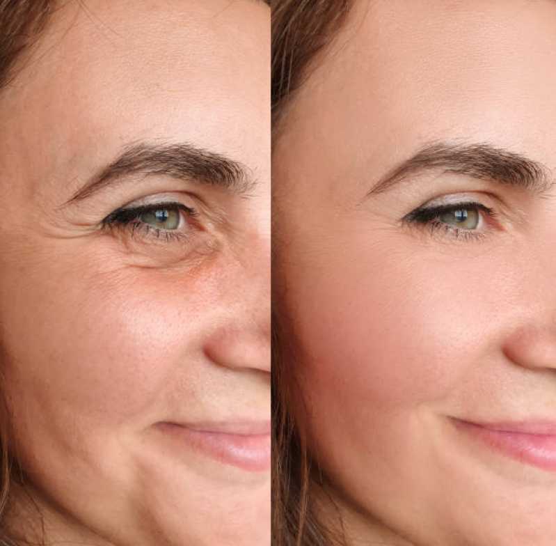 Clínica Especializada em Estética Facial para Preenchimento Taboão da Serra - Estética Rosto Feminino