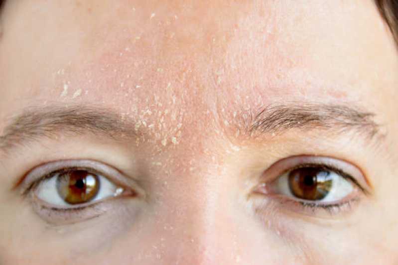 Clínica Especializada em Estética Facial Peeling Dourados - Estética Rosto Feminino