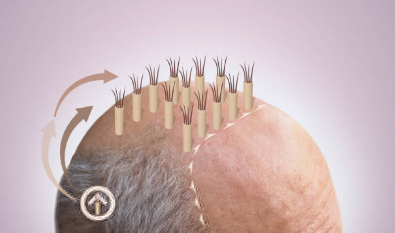 Clínica Implante Cabelo Parelheiros - Clínica para Implante Capilar Anápolis