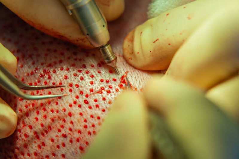 Clínica para Implante Capilar Telefone Moema Índios - Clínica de Implante de Cabelo