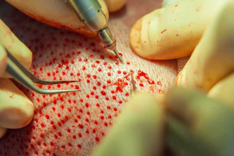 Clínica para Implante Capilar Caieiras - Clínica para Tratamento de Cabelo