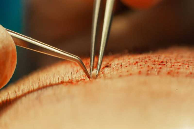 Clínica Que Faz Implante Capilar Endereço Parauapebas - Clínica Implante de Cabelo Goiânia