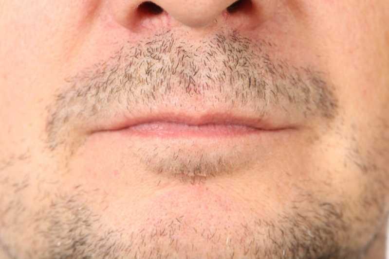 Contato de Clínica de Implante para Barba Rala Guará - Clínica de Implante Capilar na Barba São Paulo