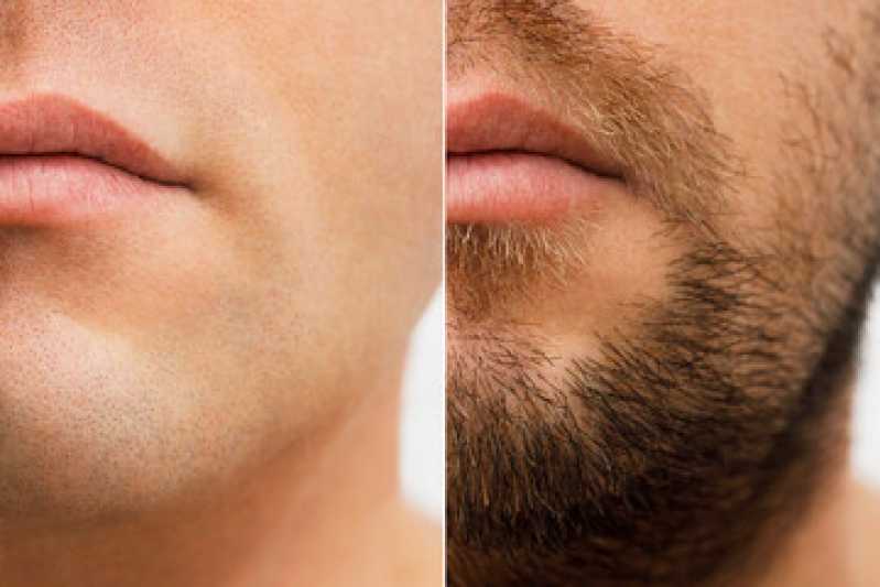 Endereço de Clínica de Implante Capilar de Barba Caieiras - Clínica de Implante na Barba