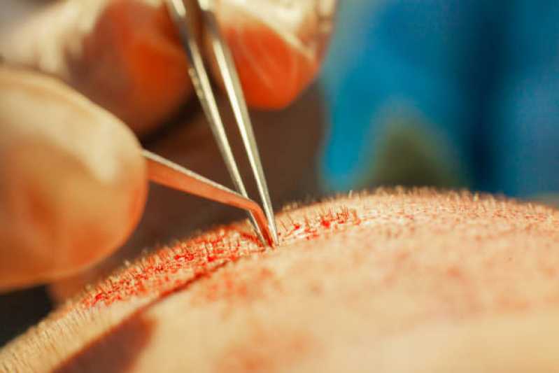Endereço de Clínica de Implante de Cabelo Peruíbe - Clínica de Implante de Cabelo