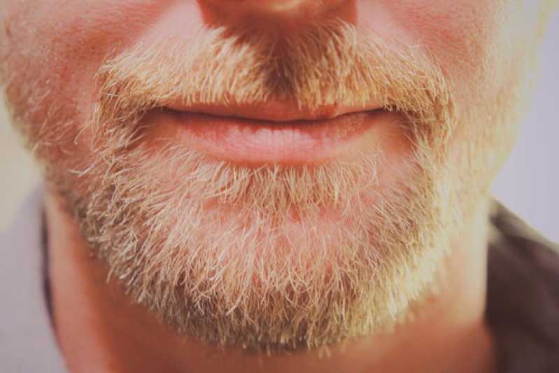 Endereço de Clínica de Implante para Barba Tatuapé - Clínica de Implante para Barba Rala
