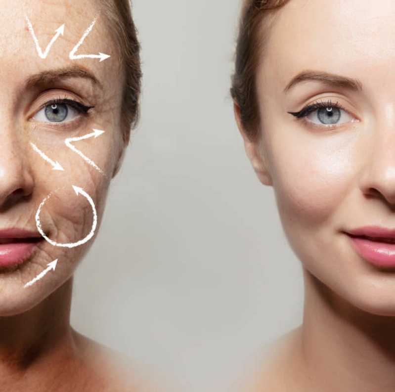 Estética Facial para Rejuvenescimento Clínica Barra do Garças - Estética Facial Peeling
