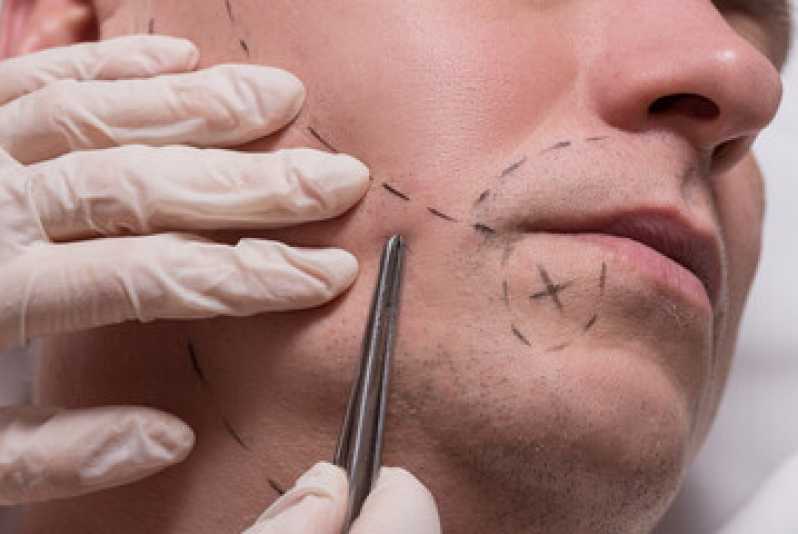 Implante Bigode Clínica Tijuco Preto - Implante para Barba
