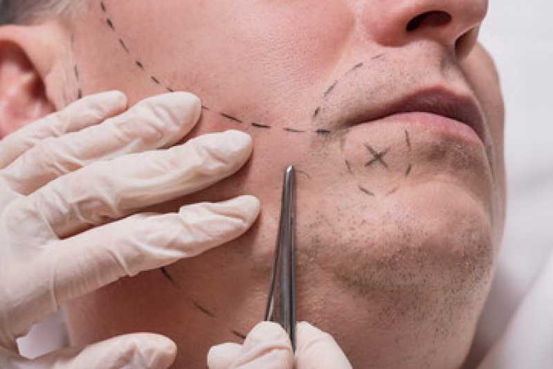 Implante Bigode Preços Carapicuíba - Implante para Barba Rala