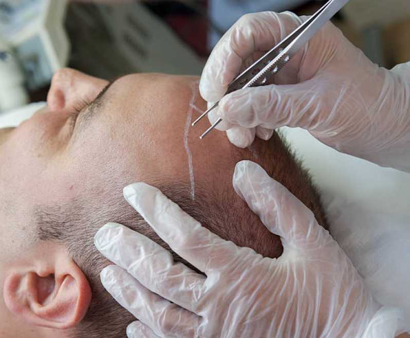 Implante Cabelo Feminino Preço São Sebastião - Implante de Cabelo Masculino