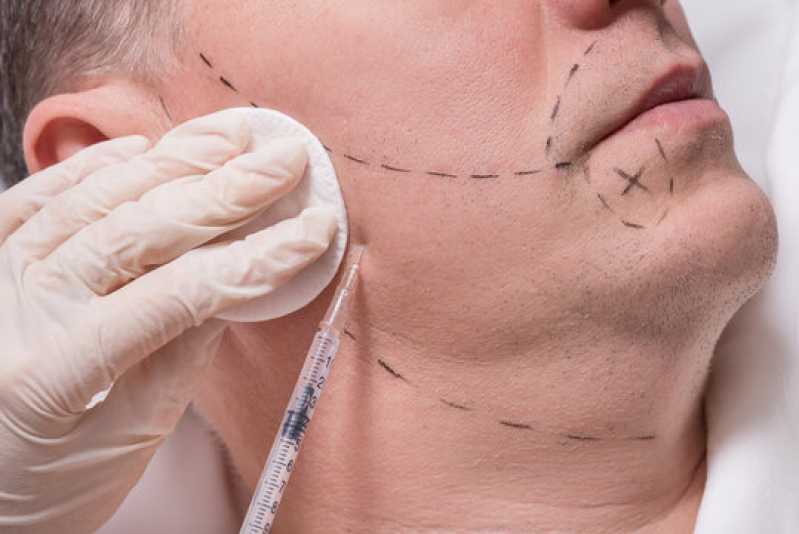 Implante Capilar Barba Abadiânia - Implante para Barba