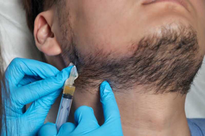 Implante Capilar de Barba Tijuco Preto - Implante Capilar para Barba Rala