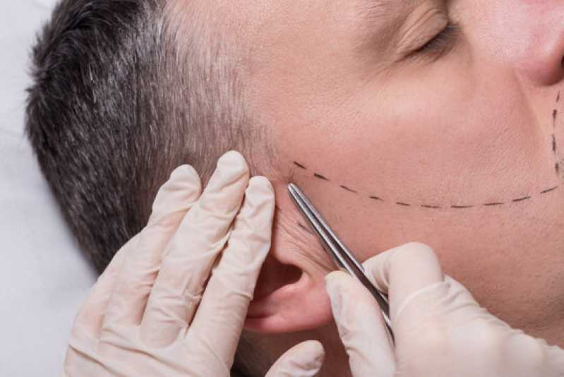 Implante Capilar na Barba Clínica Zona Oeste - Implante de Bigode