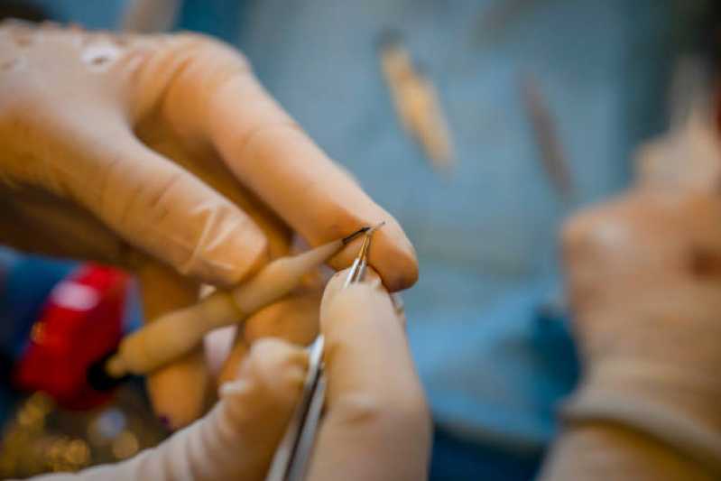 Implante Capilar para Diminuir a Testa Pedreira - Implante Capilar Feminino