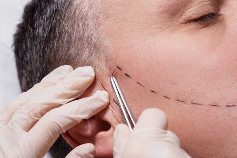 Implante de Barba Rala Lagoa Santa - Implante na Barba
