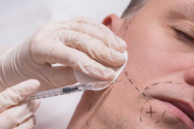Implante para Barba Clínica Recanto das Emas - Implante Capilar de Barba