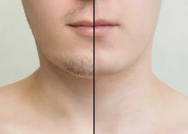 Implante para Barba Rala Uruaçu - Implante na Barba
