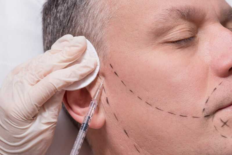 Implante para Barba Bela Vista de Goiás - Implante Capilar Barba