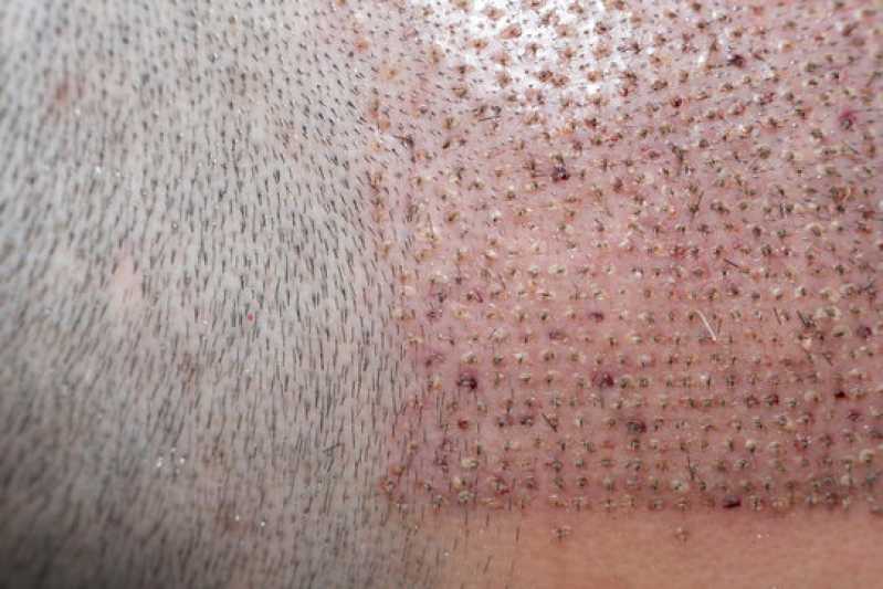 Onde Fazer Implante Capilar de Barba Peruíbe - Implante para Barba