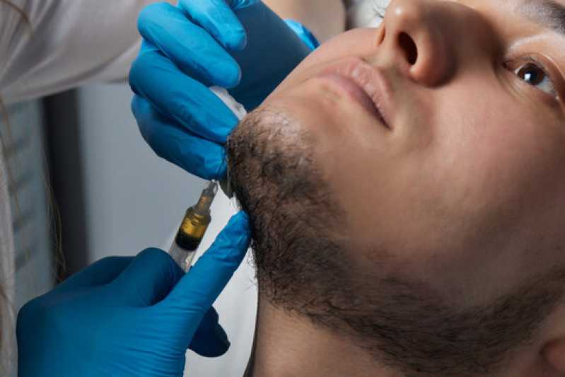 Onde Fazer Implante para Barba Rala Nova Aurora - Implante de Barba Rala
