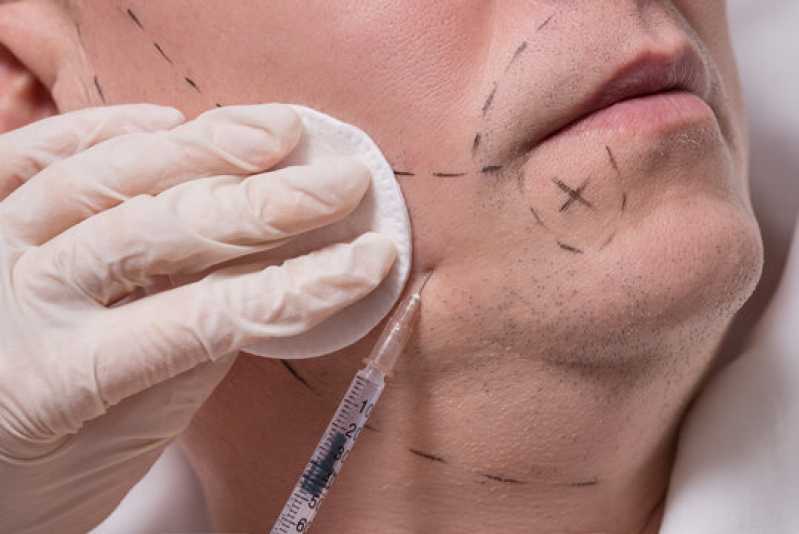 Onde Fazer Implante para Barba Saúde - Implante de Bigode