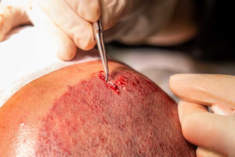 Onde Fazer Tratamento Calvície Homem Tatuapé - Tratamento com Microagulhamento para Calvície