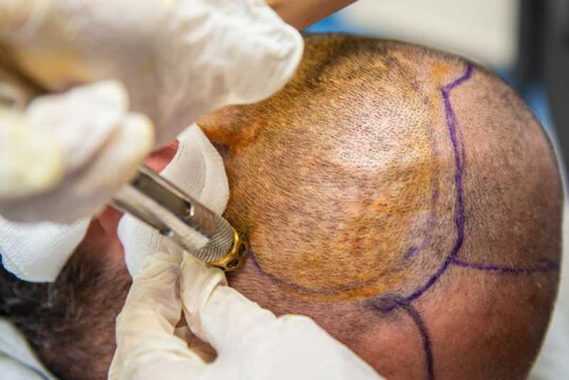 Onde Fazer Tratamento Calvície Masculina Caieiras - Tratamento com Microagulhamento para Calvície