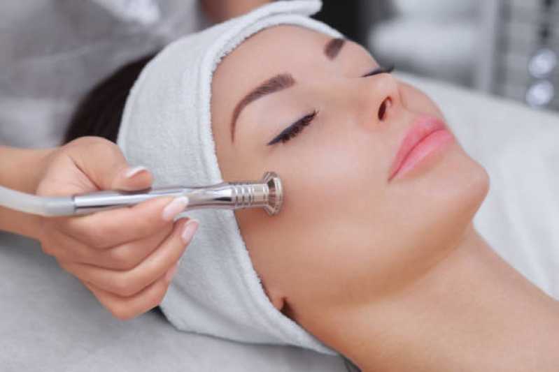 Onde Fazer Tratamento de Peeling para Poros Dilatados Vila Mariana - Tratamento de Peeling a Laser