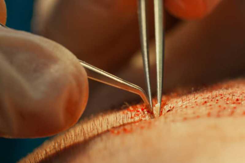 Preço de Cirurgia de Transplante Cabelo Feminino Mogi Mirim - Cirurgia de Transplante de Cabelo Masculino