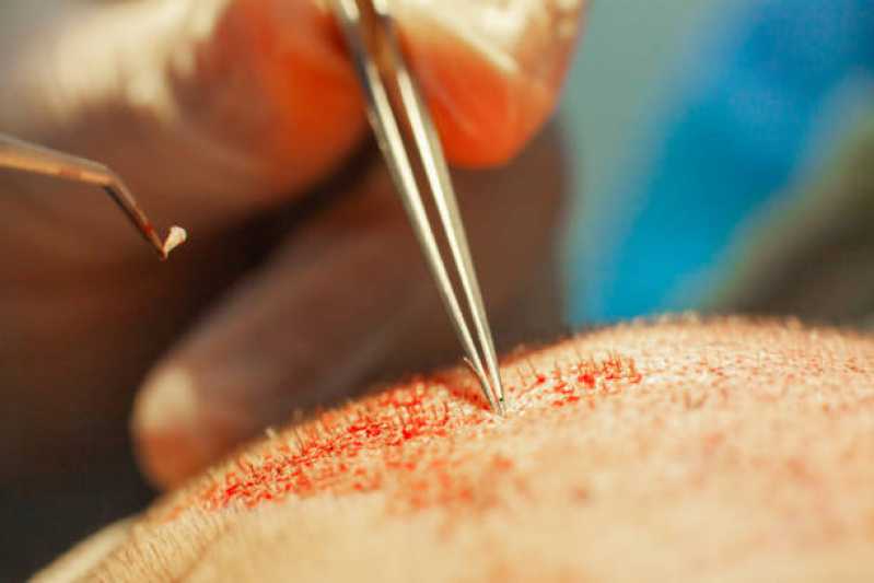 Preço de Cirurgia de Transplante de Cabelo Mulher Tatuapé - Cirurgia de Transplante de Cabelo Feminino